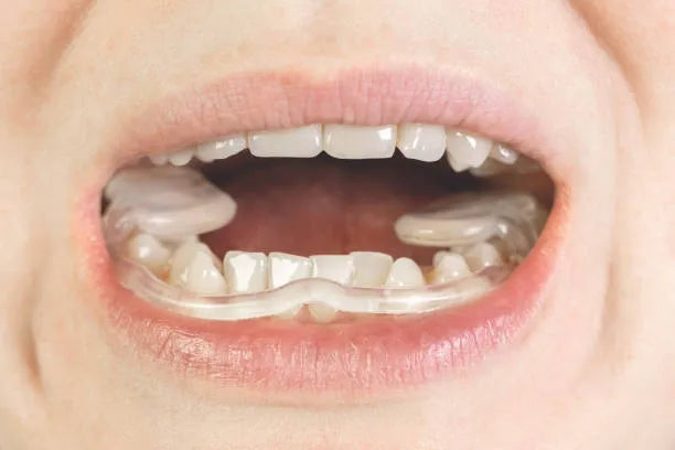 Close-up of a tongue crib orthodontic appliance for adults