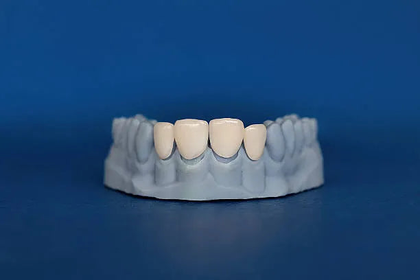 Porcelain veneer shells prepared for post-braces cosmetic treatment