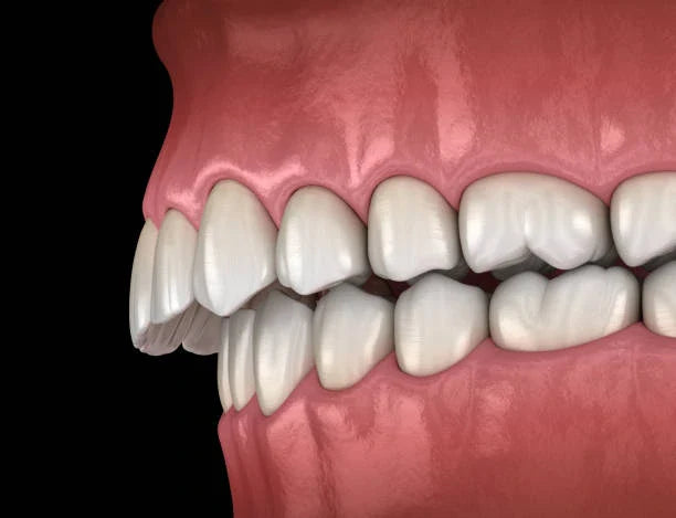 😬 Underbite Correction: Retainers vs. Braces