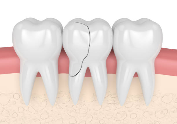 🦷 Cracked Teeth: How Retainers Protect You