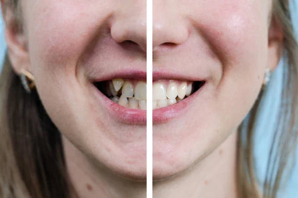 Women smiling, showcasing their brightened smiles before and after teeth straightening treatment