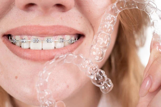 🤔 Retainers & Braces: Can You Use Both?