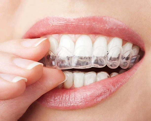 🌿 Retainers & Gum Health: What to Watch For