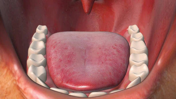 Illustration of a tongue sores