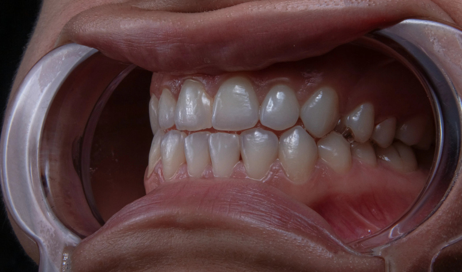 The Ultimate Guide to Clear Retainers: Everything You Need to Know