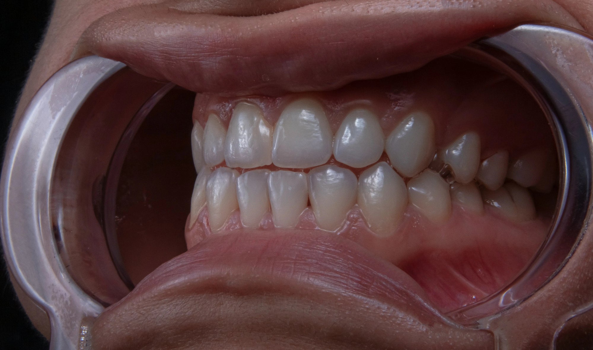 The Ultimate Guide to Clear Retainers: Everything You Need to Know