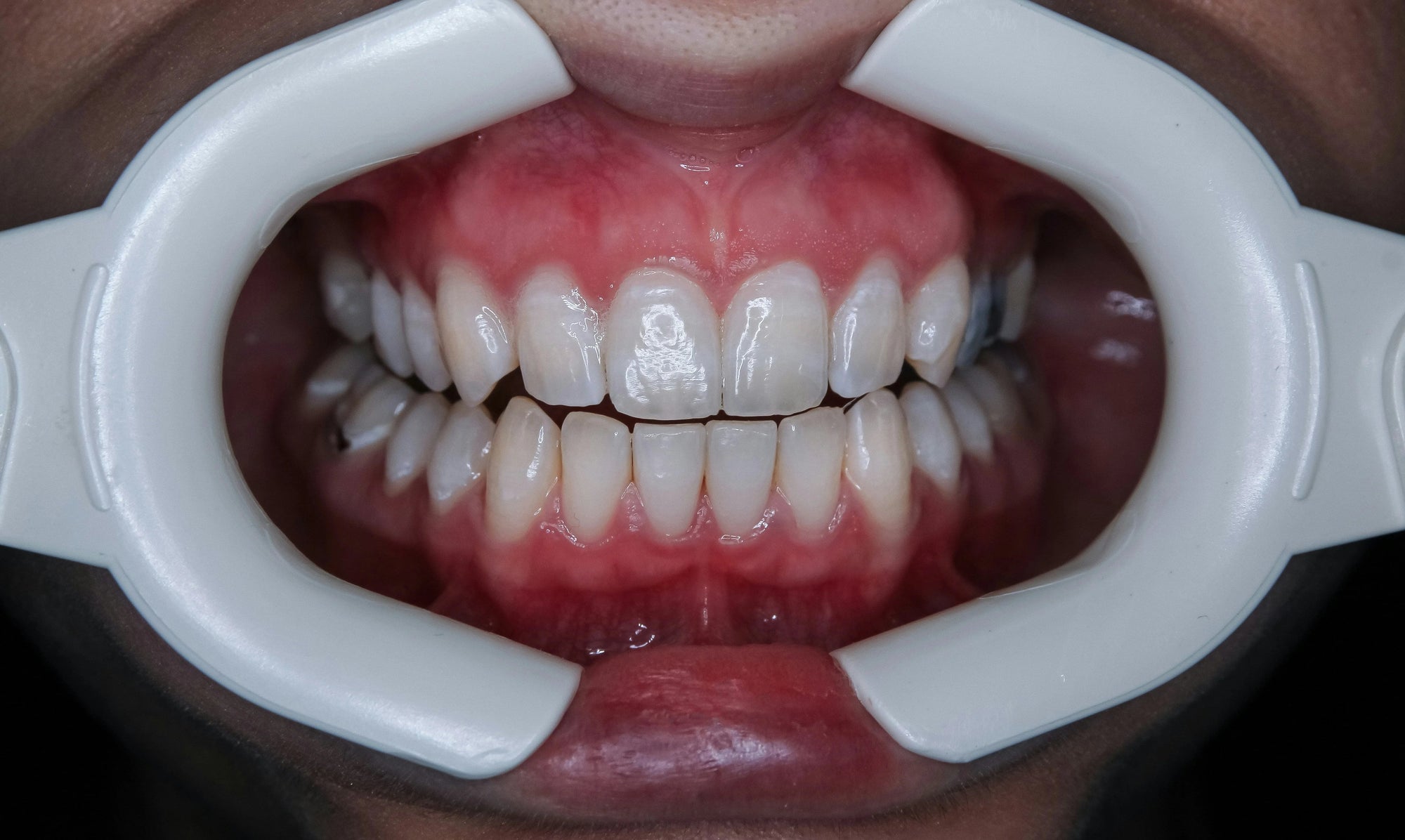 The Silent Revolution: How Clear Aligners Are Reshaping Human Faces—Literally