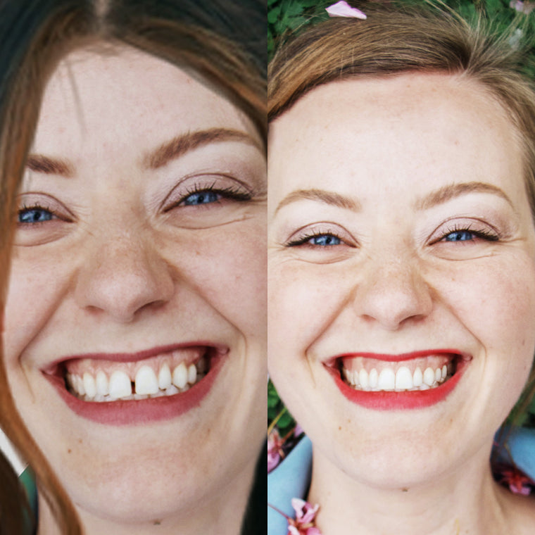 Clear Aligner Before After NewSmile Aligner Results | NewSmile 