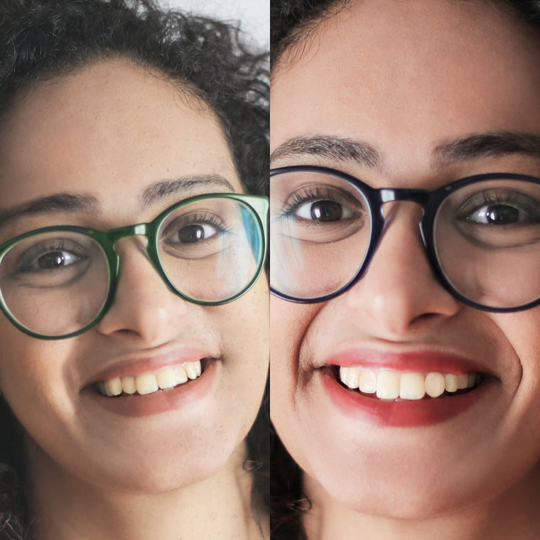 Wedding invisible braces delivered | Straight teeth for smile confidence | NewSmile