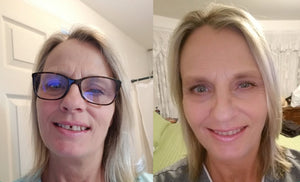 Close tooth gaps and spaces in smile | Clear aligners Canada