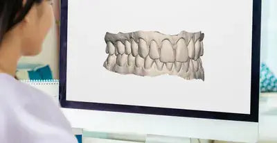 Person looking at a computer screen displaying a 3D digital scan of teeth or a dental mold, likely for treatment planning.